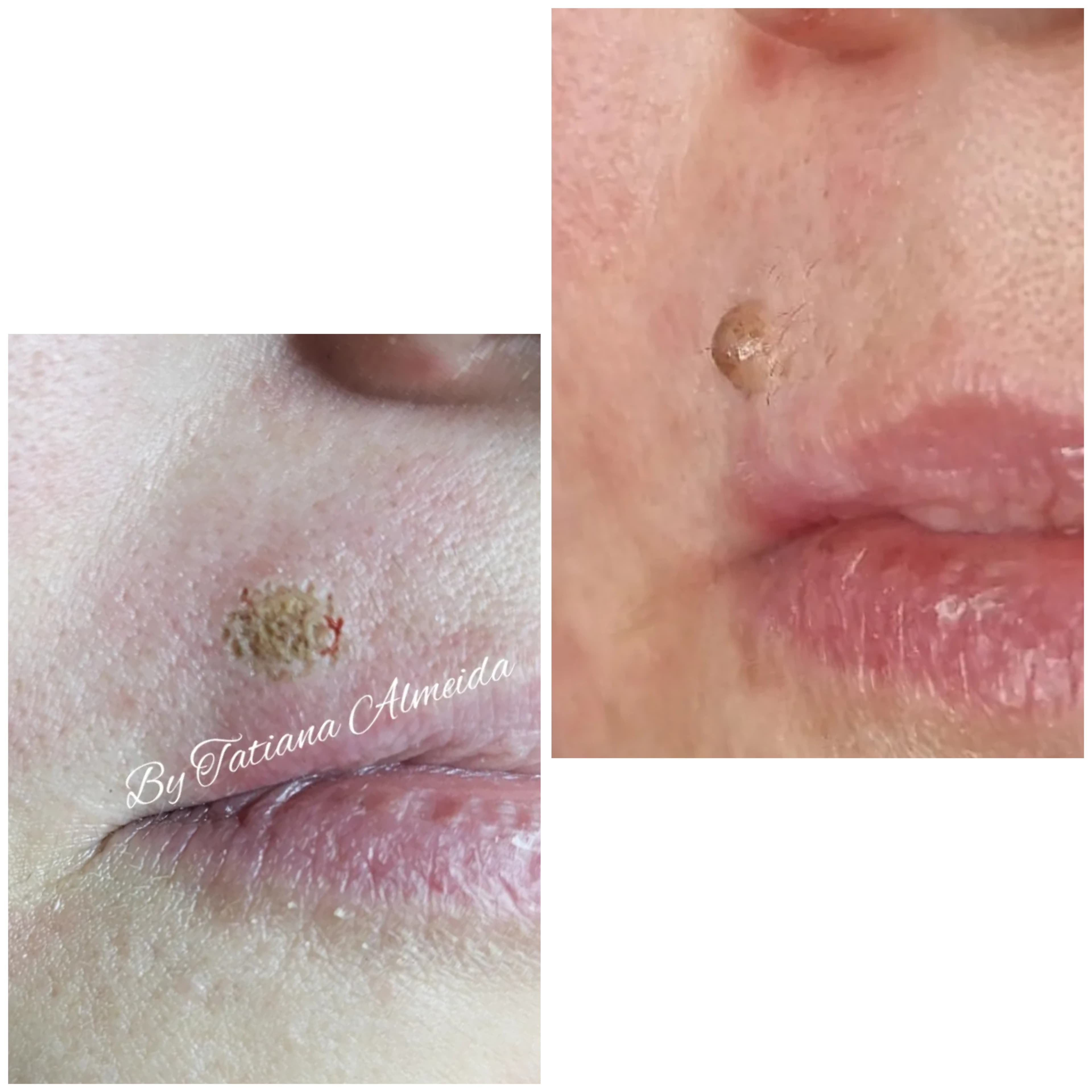 Gros plan d'un grain de beauté avant et après traitement sur la lèvre supérieure.