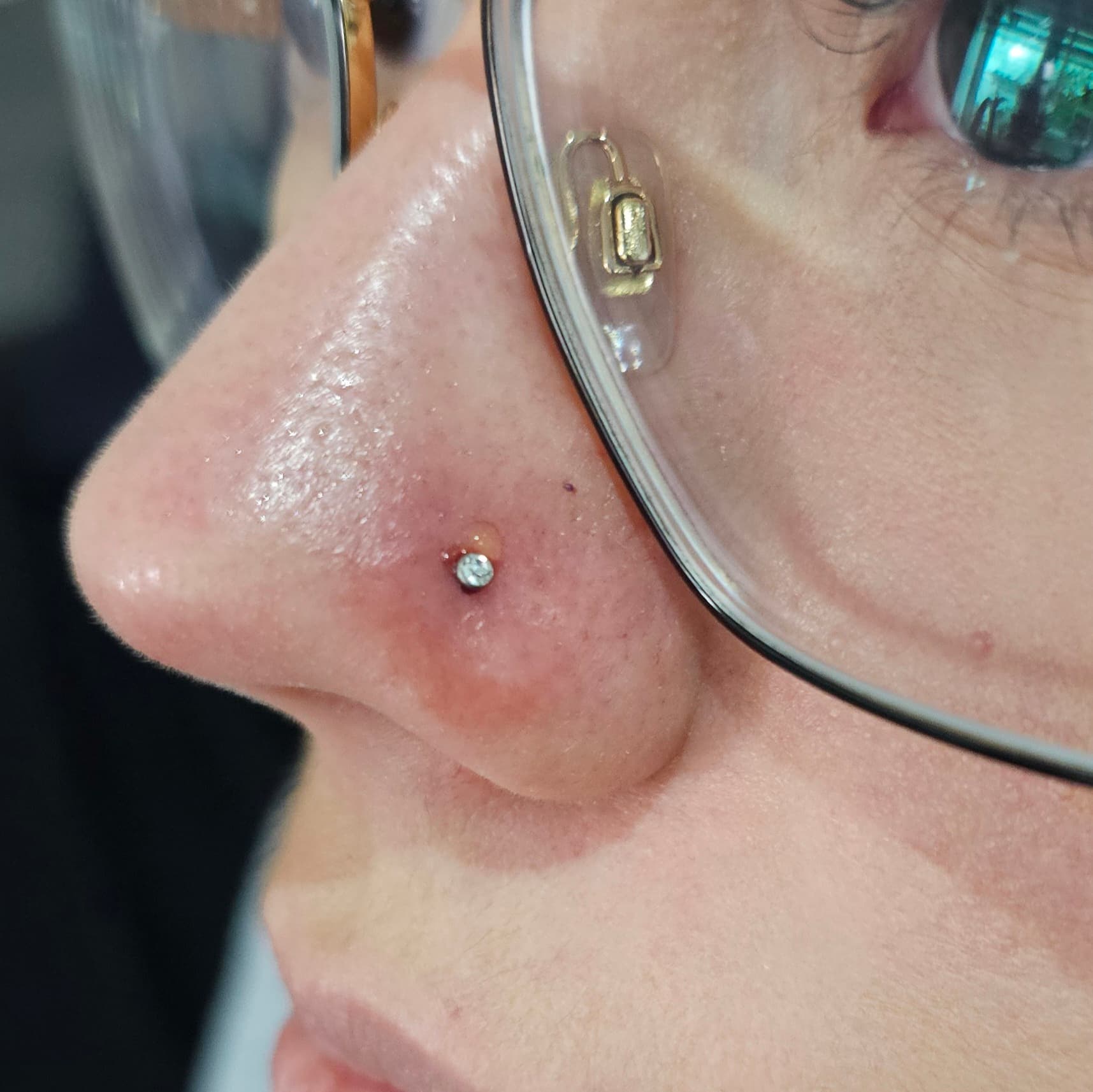 Piercing à la narine présentant une petite bosse d'irritation jaunâtre sur une peau rouge.